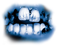 Los ingredientes tóxicos en el meth provocan caries grave conocida como “boca de meth”. Los dientes se vuelven negros, se manchan y se pudren, frecuentemente hasta el punto en que tienen que sacarse. Los dientes y encías se destruyen en la parte interior, y las raíces se pudren.